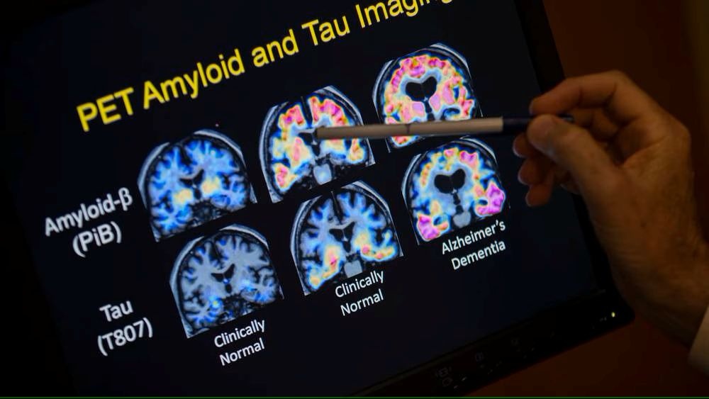 Europejska Agencja Leków dopuściła do obrotu lek na Alzheimera