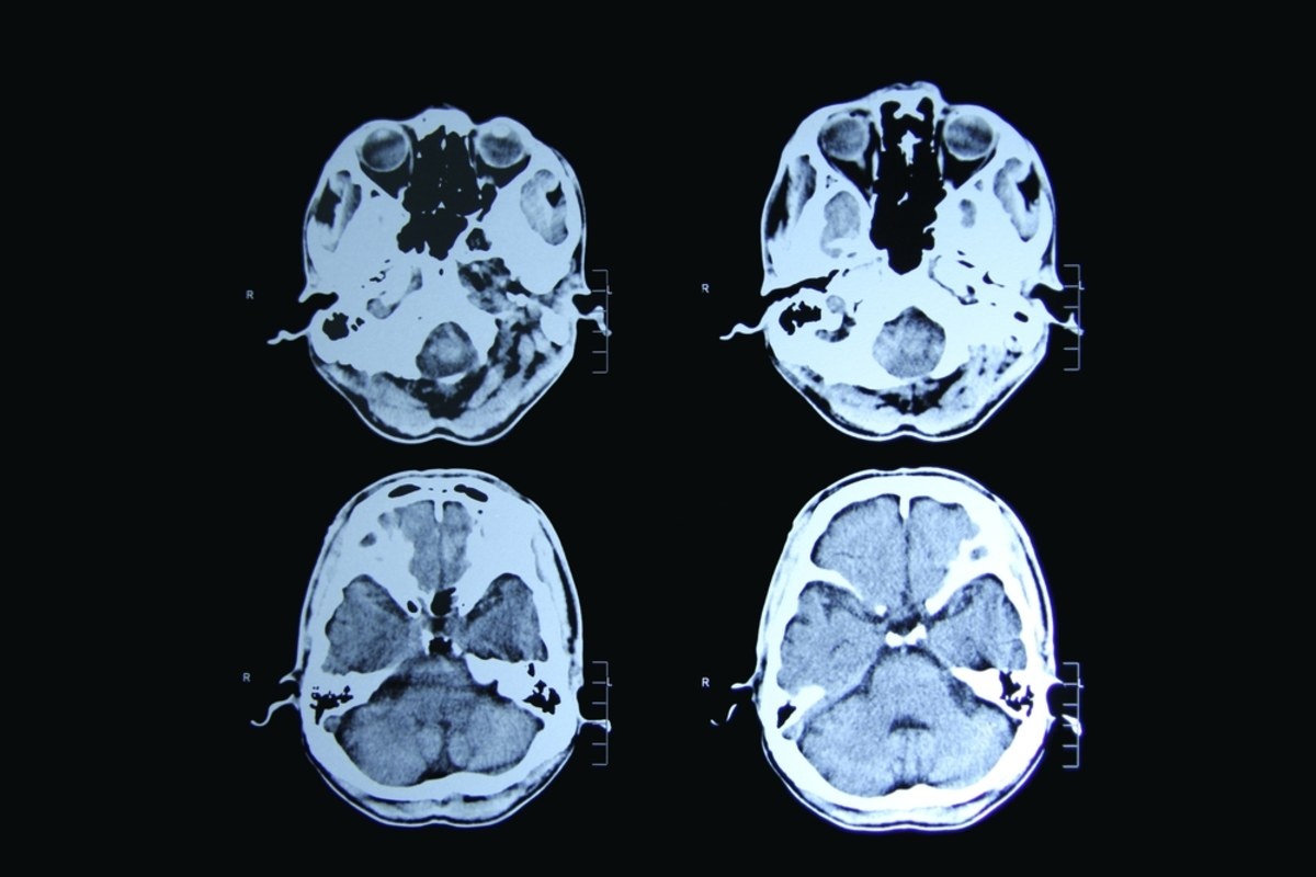 Absolutny przełom w leczeniu choroby Huntingtona