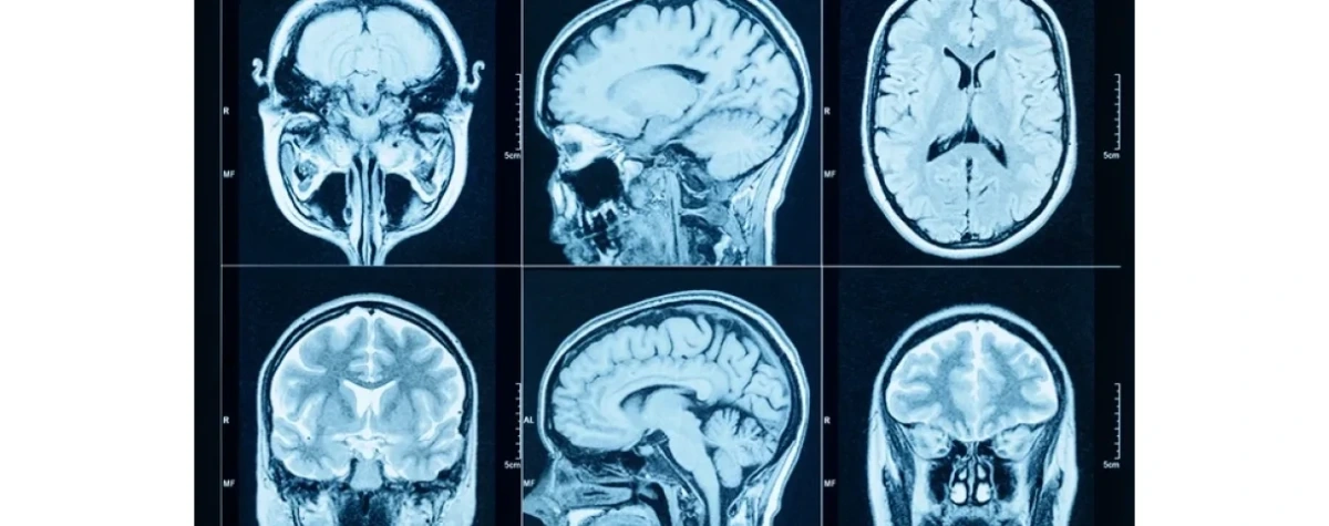 Naukowiec bada, jak „odkliknąć” w mózgu PTSD
