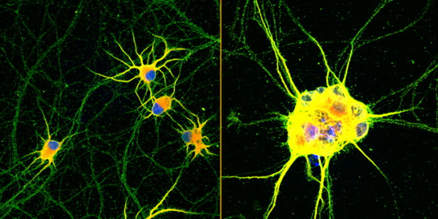 Nowa nadzieja dla milionów chorych. W laboratorium „wyhodowano” dojrzałe neurony