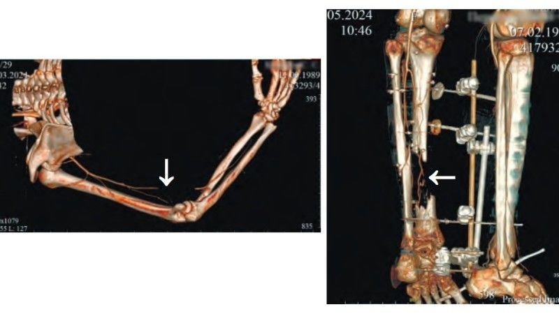 Rosja: Ukraińskie drony odpowiadają za 75% rosyjskich strat osobowych