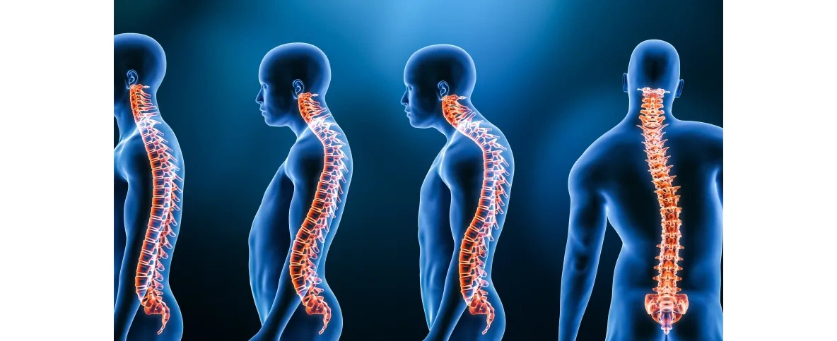 Polscy naukowcy współtwórcami gorsetu do leczenia skoliozy u młodzieży