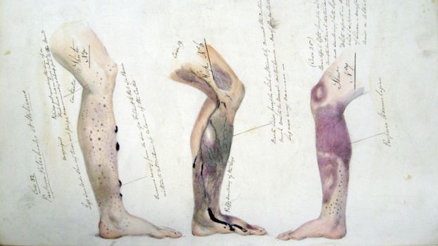 Szkorbut – przekleństwo marynarzy epoki żagli » Historykon.pl