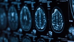 Neurolodzy: Polska nie jest gotowa zmierzyć się z wyzwaniem, jakim są choroby mózgu