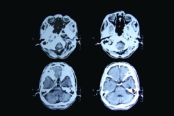 Absolutny przełom w leczeniu choroby Huntingtona