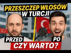 Celebryci po przeszczepie włosów. Cała PRAWDA o przeszczepie włosów w Turcji. WARTO CZY NIE?