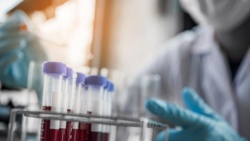 Katowice/ Pierwsze w Polsce zastosowanie leku w terapii obniżającej poziom złego cholesterolu