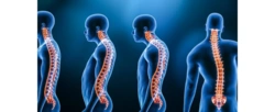 Polscy naukowcy współtwórcami gorsetu do leczenia skoliozy u młodzieży