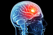 Przełom w diagnostyce raka mózgu - ultradźwięki zamiast ryzykownej biopsji