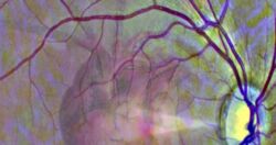 Badanie oka może przewidzieć atak serca