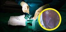 Przez 20 lat żyła z nożyczkami w brzuchu. Chirurg zostawił je podczas operacji